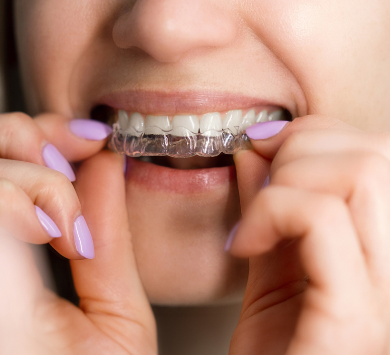 Is Invisalign right for you?